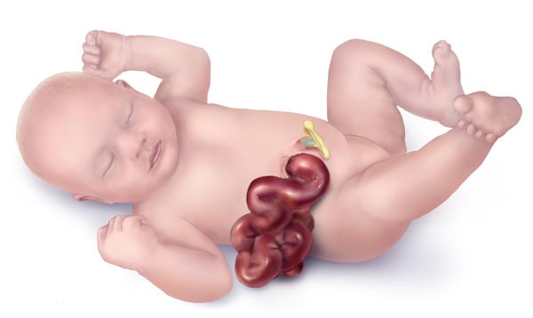 Gastroskisis
